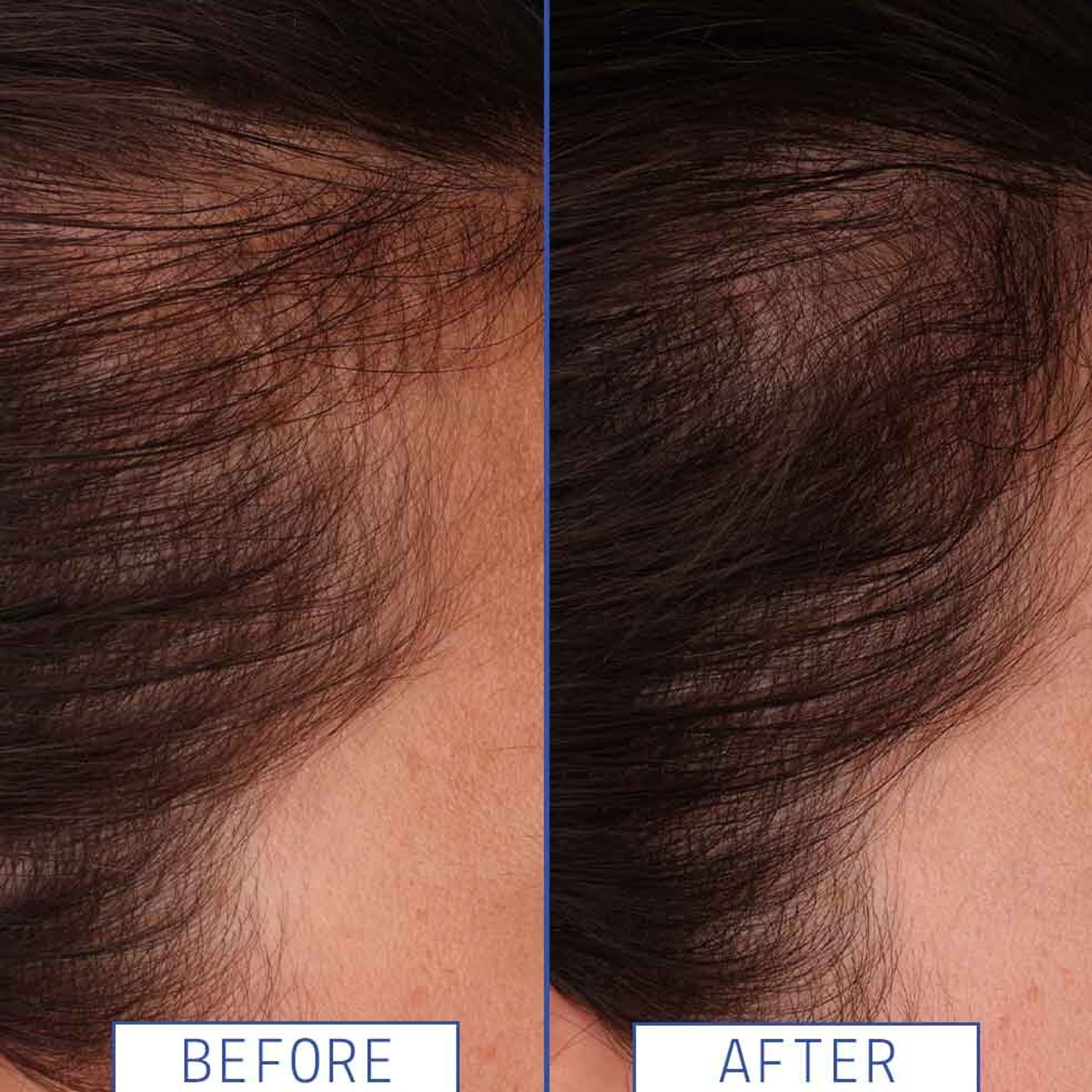 Hair Density Boosting Treatment