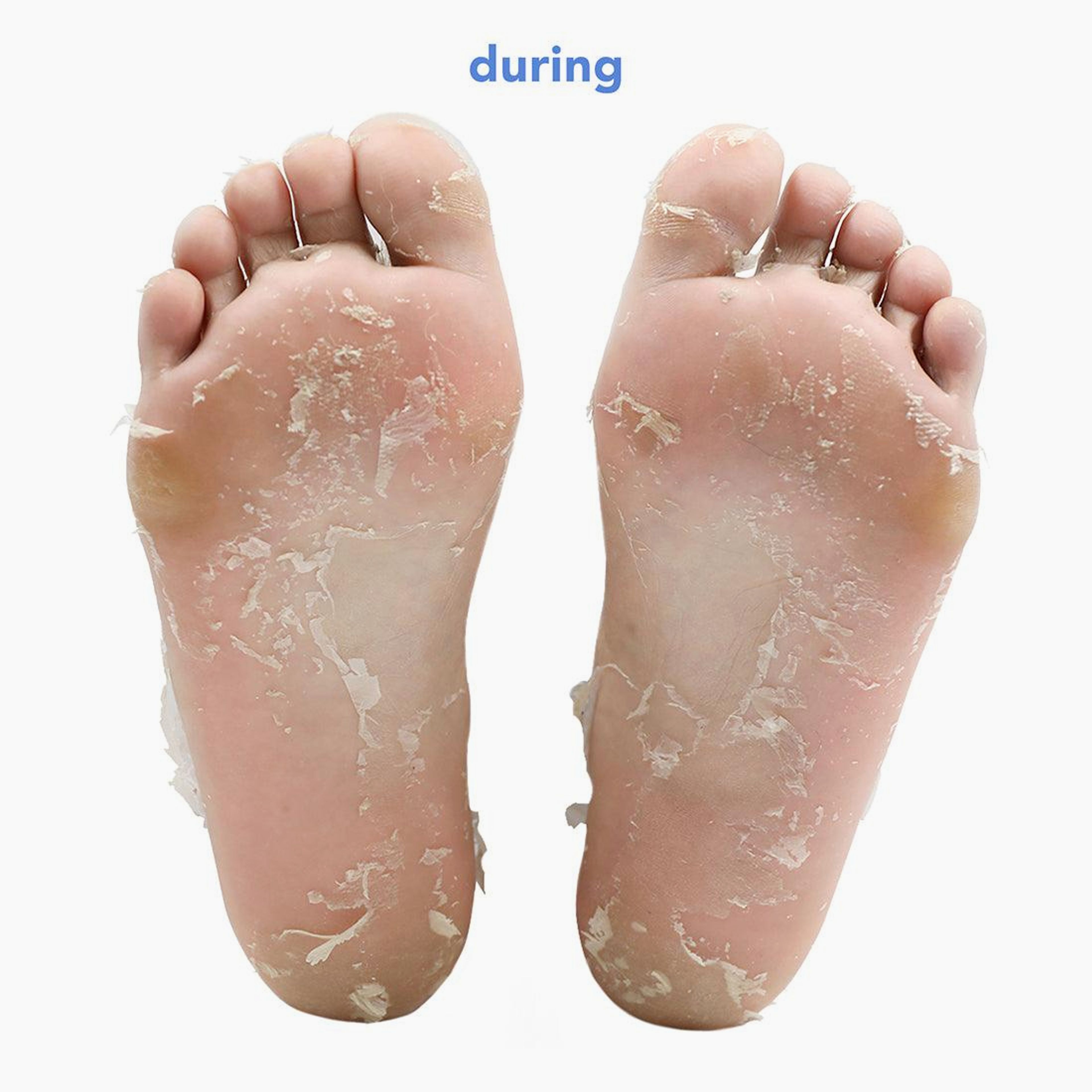 Fruit Acid Smoothing Foot Peel with plant-based alcohol
